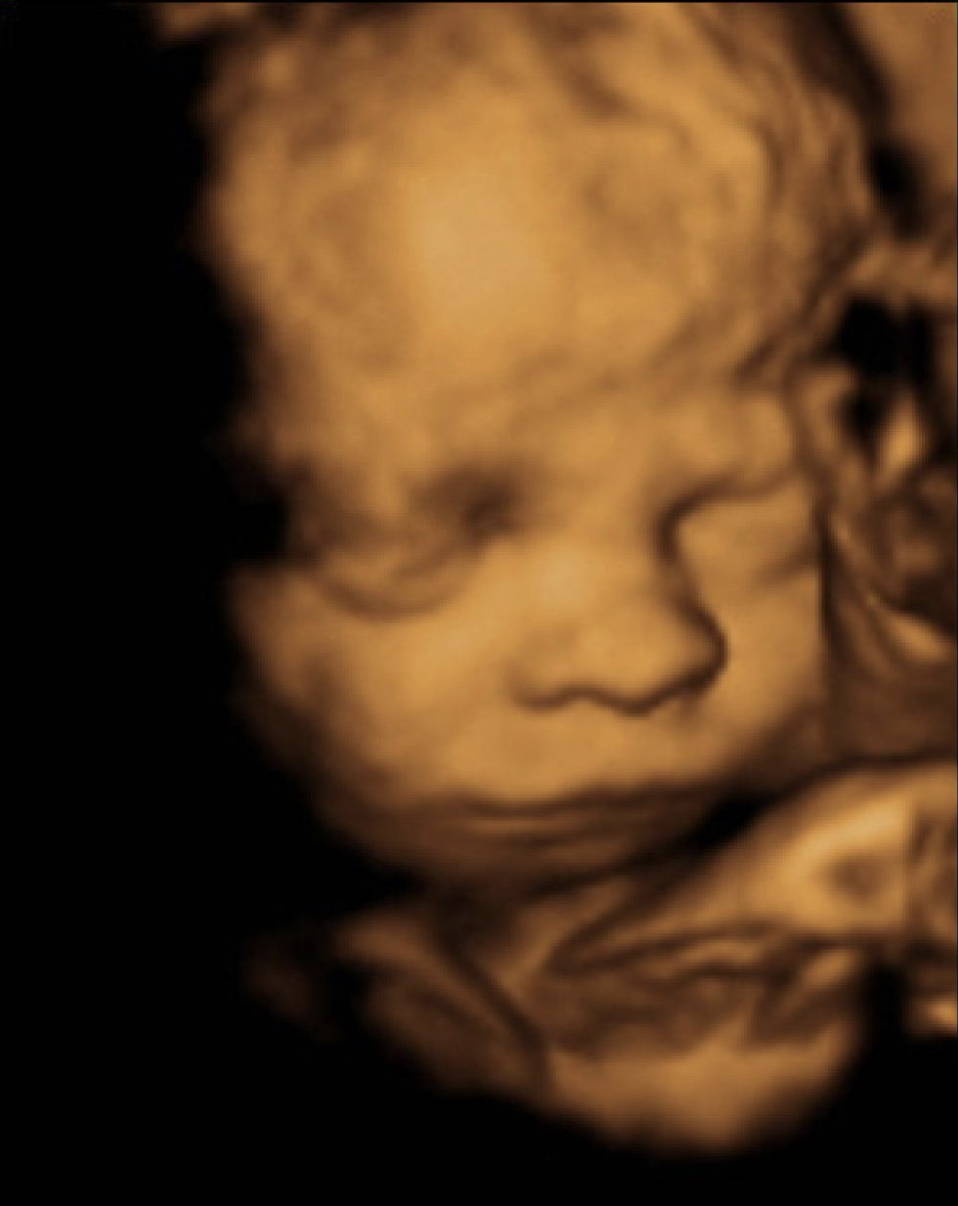 3D ultrasound before WombView baby portrait